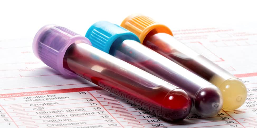 Vials of blood from the laboratory services