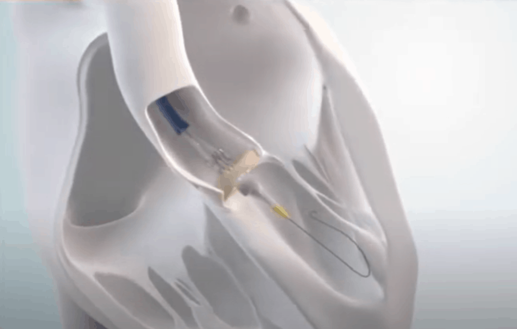 TAVR Procedure