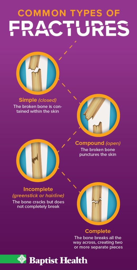 Infographic- Common Types of Fractures Explained