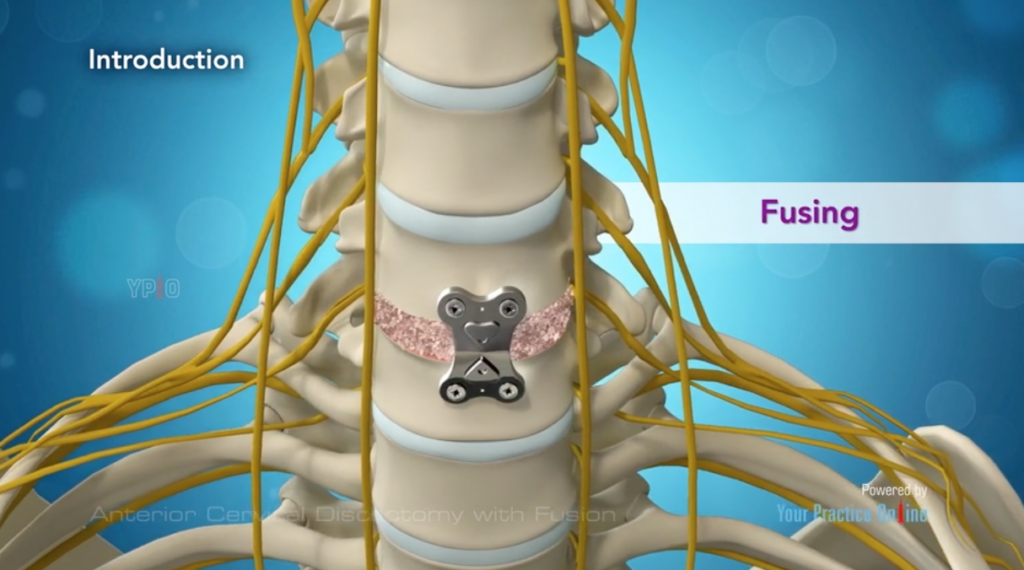 Anterior Cervical Discectomy with Fusion B
