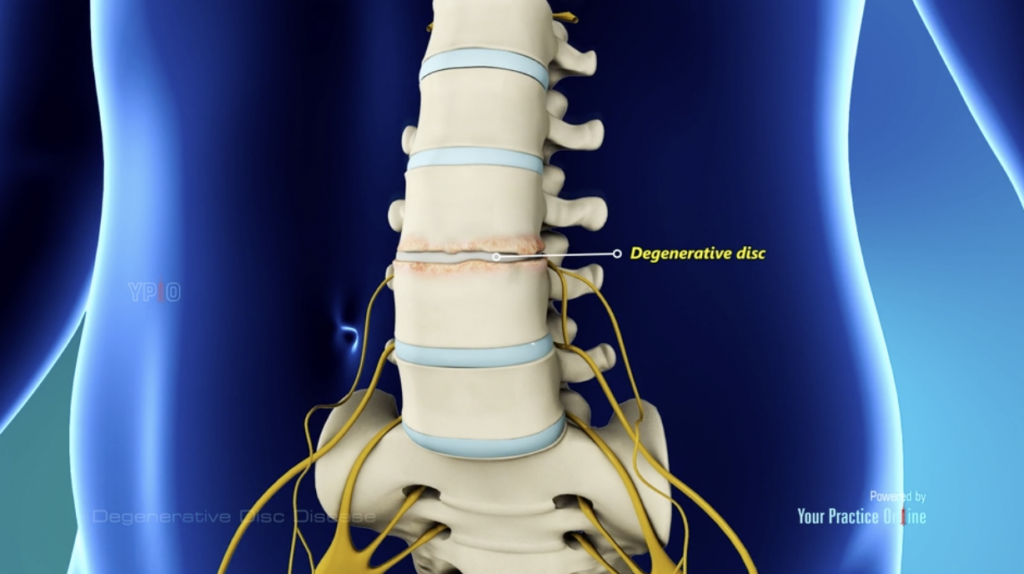 Degenerative Disc Disease