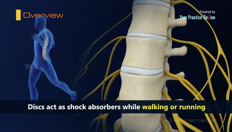 Disc Herniation