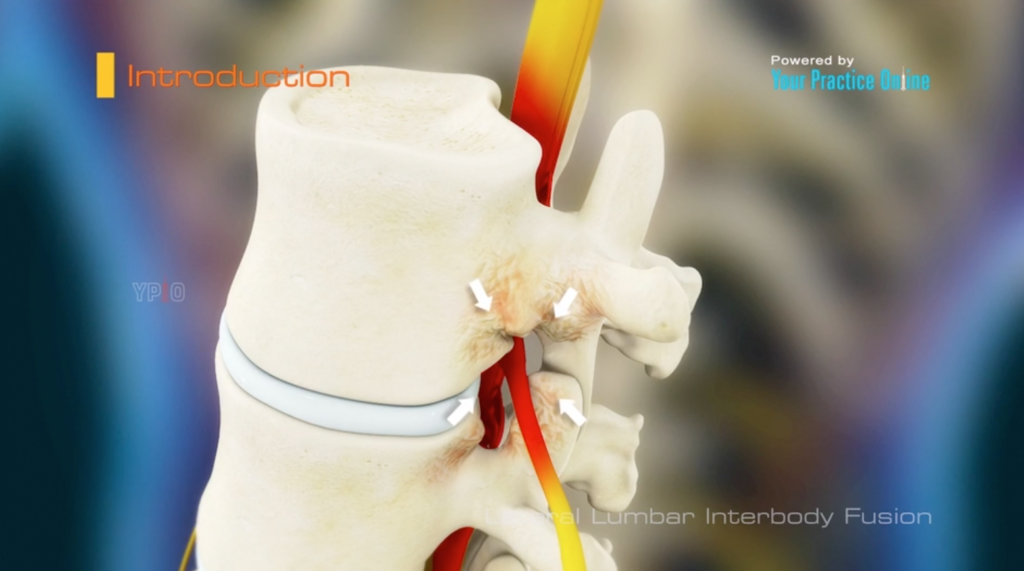 Lateral Lumbar Interbody Fusion