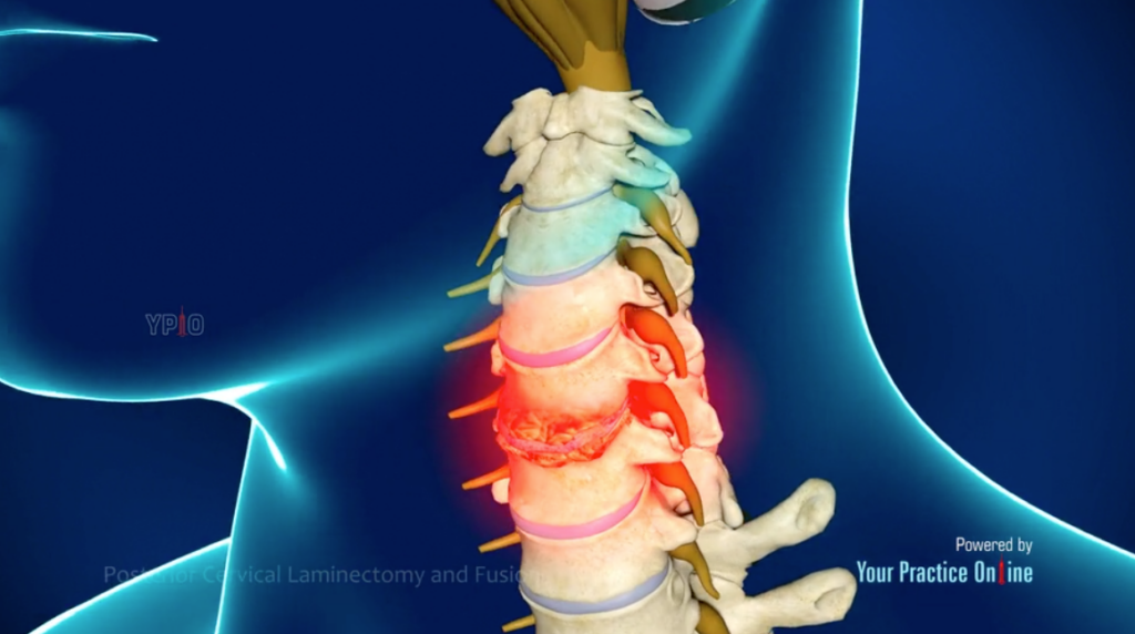 Posterior Cervical Laminectomy and Fusion​