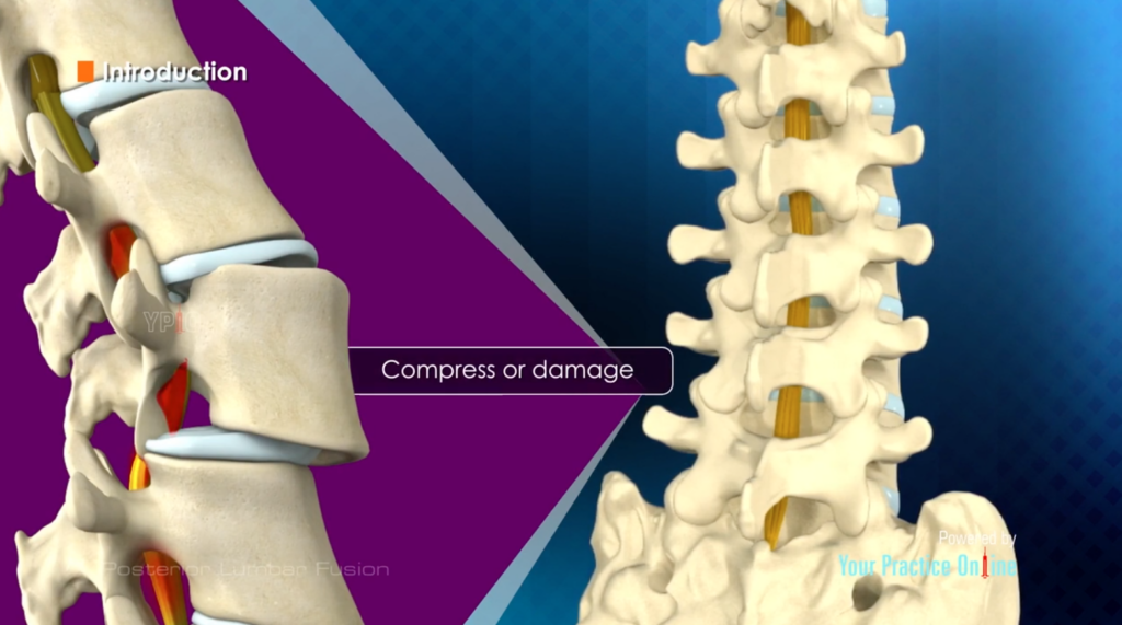 Posterior Lumbar Fusion