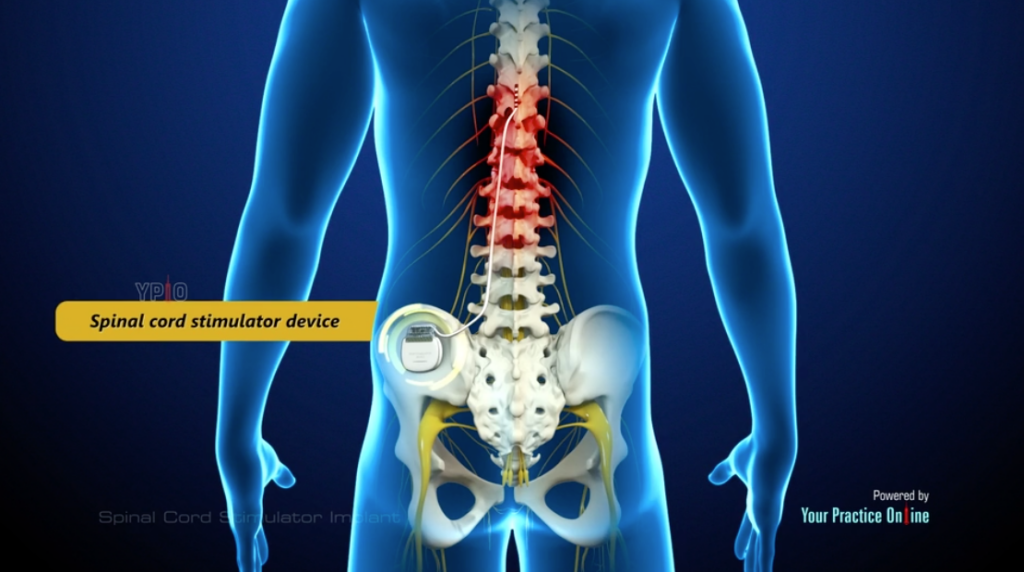 Spinal Cord Stimulator Implant​​