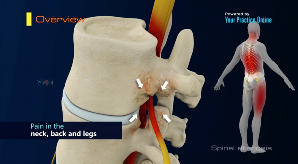 Spinal Stenosis​ 2