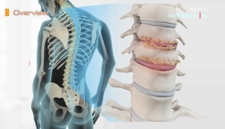 Spondylosis