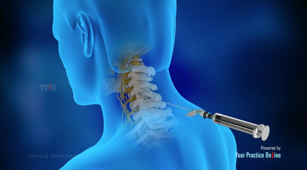 Cervical Spine Injections​